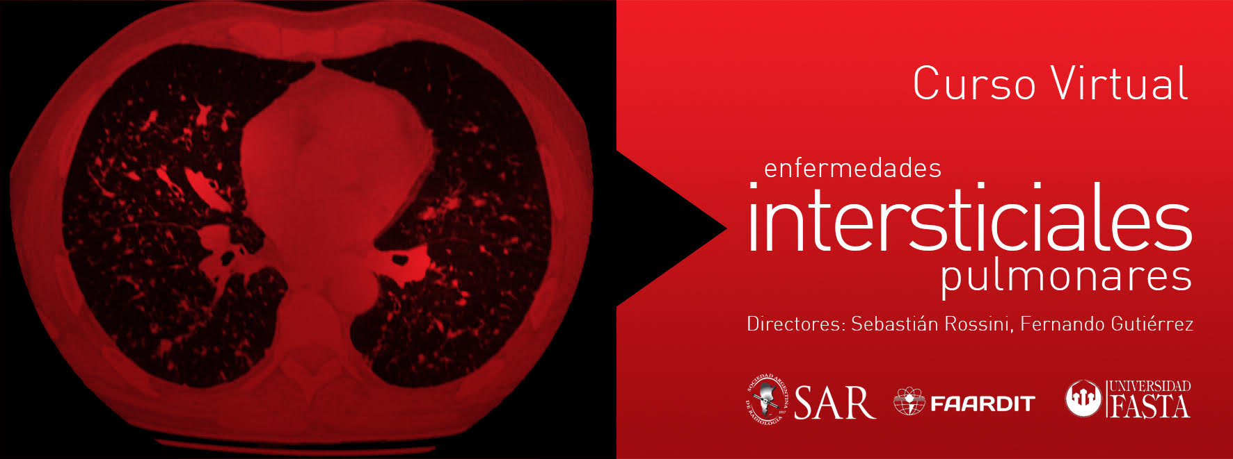 Curso Virtual de Enfermedades Intersticiales Pulmonares